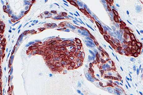 A gene family that suppresses prostate cancer