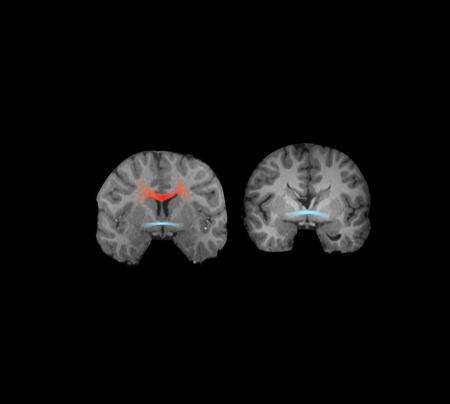 Caltech neuroscientists find link between agenesis of the corpus callosum and autism