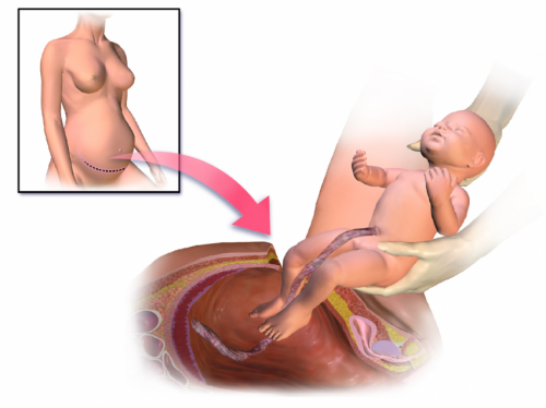 Cesarean section