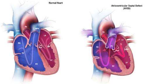 Clues to genetics of congenital heart defects emerge from Down syndrome study