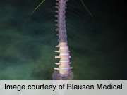 Coflex interspinous device no extra benefit in spinal stenosis