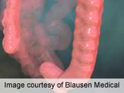 Colonoscopy is indicated in unscreened elderly patients