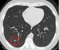 CT scans lower lung cancer deaths, according to study