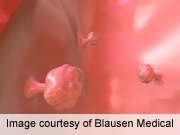 DDW: endoscopic L-menthol spray ups colon polyp detection