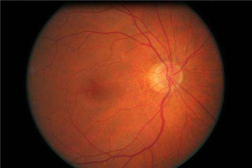 Diabetes macular edema, a underestimated visual problem