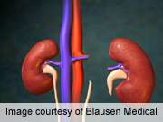 Diabetics fare well after kidney transplants, study finds