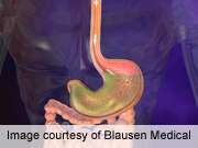 Dietary counseling has little effect after gastric bypass