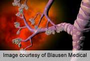 ERS: mepolizumab is glucocorticoid-sparing in asthma