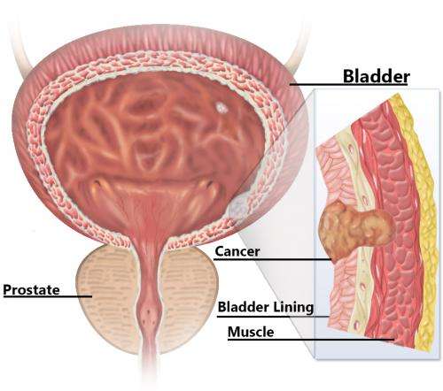 Bladder cancer study reveals potential drug targets, similarities to several cancers