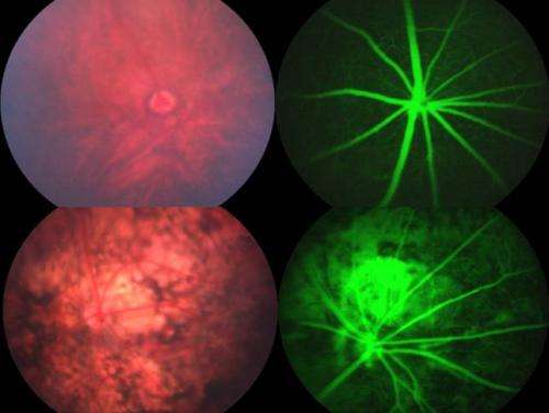 Fundoscopy of healty and disease retinal pigment epithelium