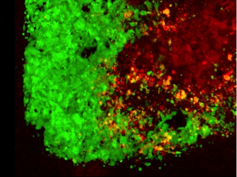 Herpes-loaded stem cells used to kill brain tumors
