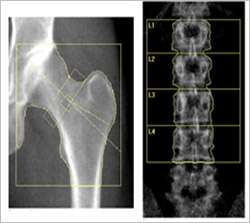 Hormone treatment restores bone density for young women with menopause-like condition