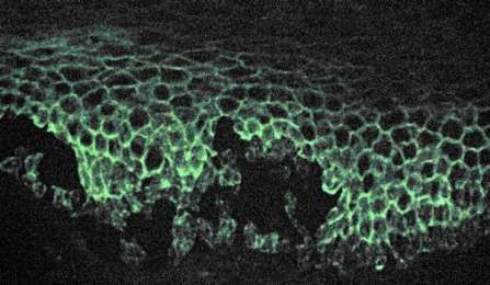 How skin falls apart: The pathology of autoimmune skin disease is revealed at the nanoscale