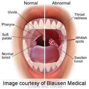 Hpv in throat Human Papillomavirus and Head and Neck Cancer hpv nin tedavisi varm