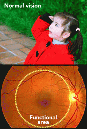 Images of normal and diseased retinas