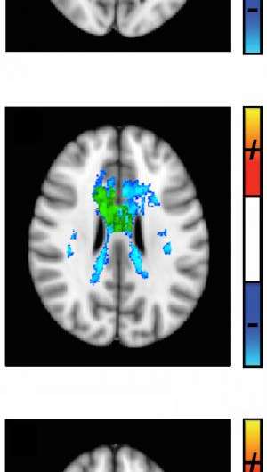 Imaging scientists develop a better tool for tracking MS