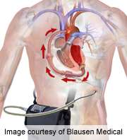Improved outcomes seen with ventricular assist devices