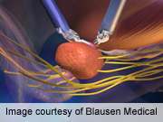 Informed consent plays major role in prostatectomy lawsuits