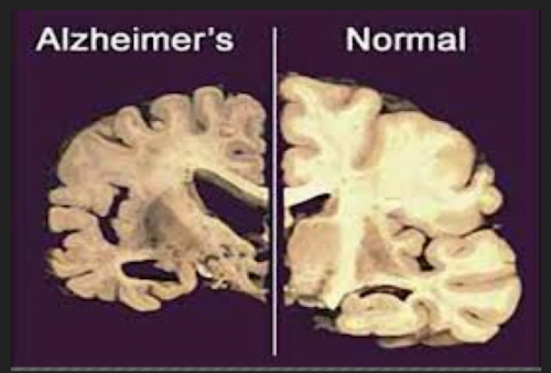 Inherited Alzheimer’s damage greater decades before symptoms appear