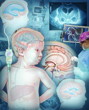 JNS: Pediatrics publishes guidelines for the treatment of pediatric hydrocephalus