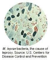 Leprosy still occurs in U.S., CDC reports