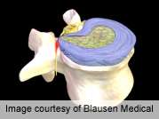 Limited microdiscectomy effective for disc herniation