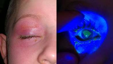 Liquid detergent pods pose risk to children's eye health