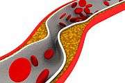 Many not treated according to 2013 cholesterol guidelines