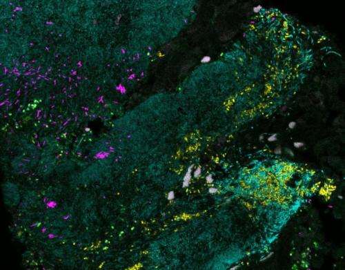 MBL imaging technique reveals that bacterial biofilms are associated with colon cancer
