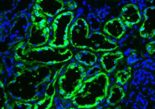 Metabolic enzyme stops progression of most common type of kidney cancer