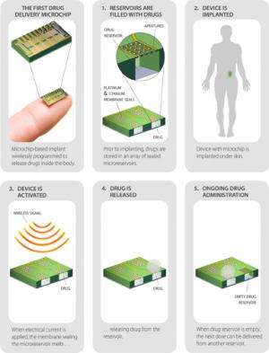 MicroCHIPS develops contraceptive implant