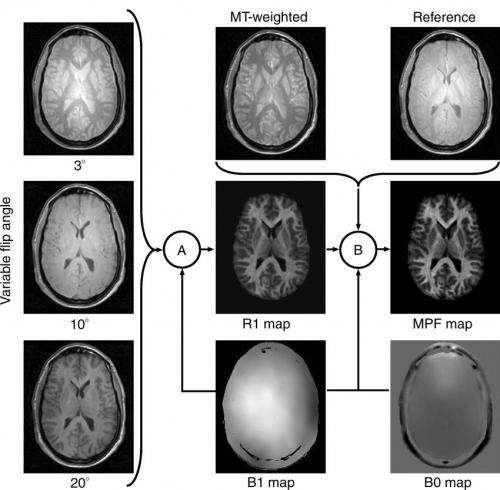 MRI shows gray matter myelin loss strongly related to MS disability