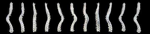 Richard III的脊椎新的3-D表示，他的脊柱侧凸的“螺旋性”