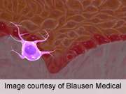 New prognostic factors may be useful in staging melanoma