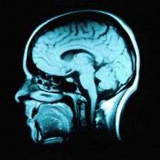 New study links Alzheimer's to brain hyperactivity