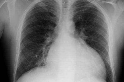 New targets for treating pulmonary hypertension found