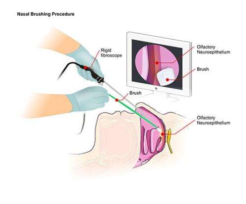 NIH and Italian scientists develop nasal test for human prion disease