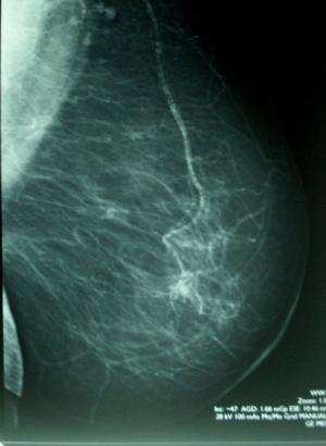 No support for increasing the volume norm for breast cancer surgery