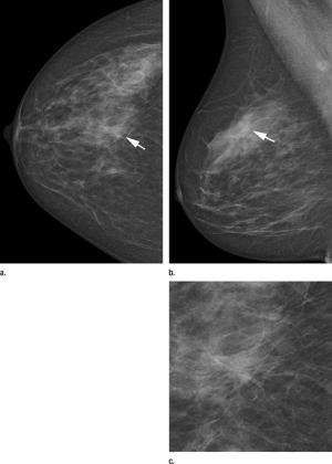 Novel technique increases detection rate in screening mammography