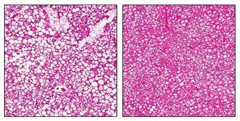 Obesity-induced fatty liver disease reversed in mice