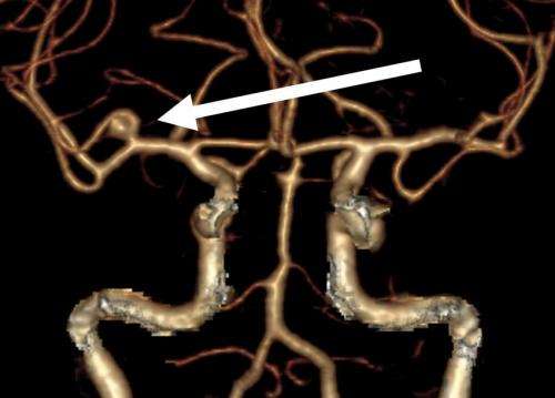 One-third of all brain aneurysms rupture: the size is not a significant risk factor