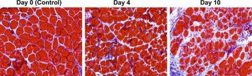 Out-of-step cells spur muscle fibrosis in Duchenne muscular dystrophy patients