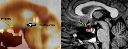 PET/CT shows pituitary abnormalities in veterans with PTSD