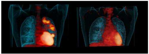 PET scans help identify effective TB drugs, says Pitt School of Medicine study