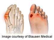 Plantar-pressure based orthoses reduce foot ulcer recurrence