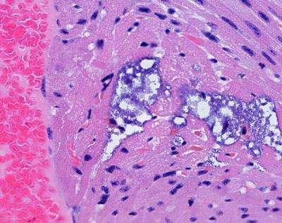 Pneumonia bacterium leaves tiny lesions in the heart, study finds