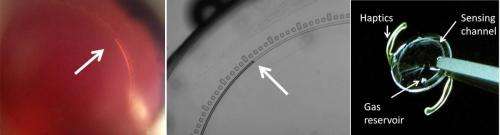 Researchers develop artificial lens based glaucoma sensor