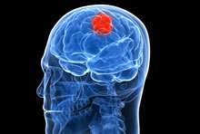 Progesterone could become tool versus brain cancer