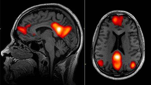 Reported 'neuroimage bias' not as strong as first believed