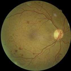 Research presents new hope of early diagnosis of major cause of blindness